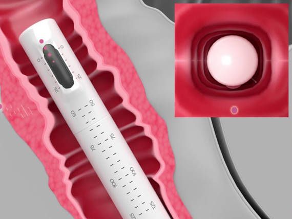 HIFU VAGINAL