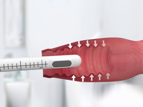 HIFU VAGINAL